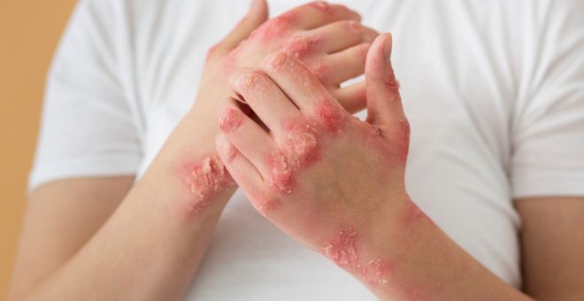 Epidermolysis bullosa – Symptome und Behandlung